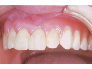 valplast_bite